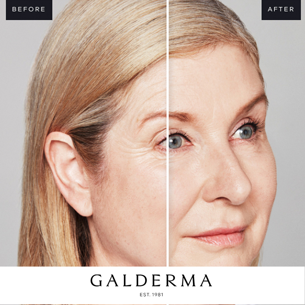 Skinboosters Galderma